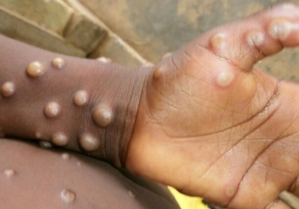 monkeypox